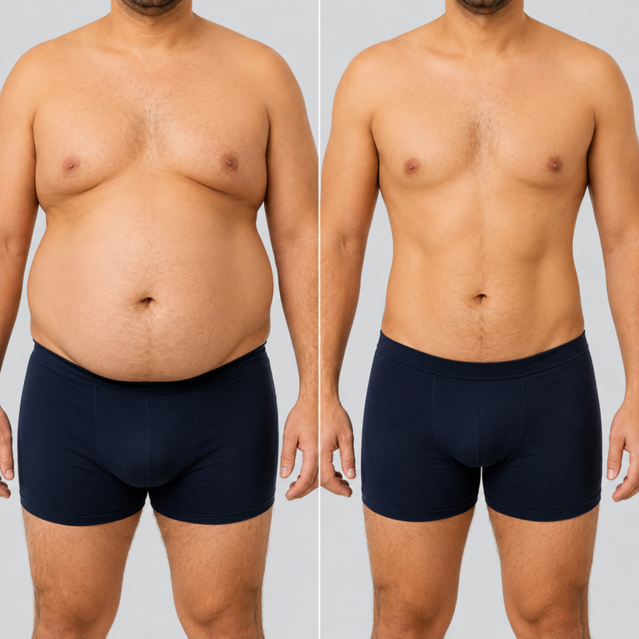 Gastric Balloon