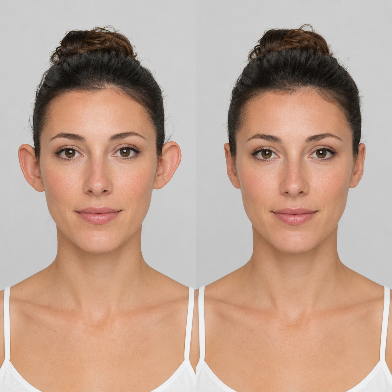 Otoplasty