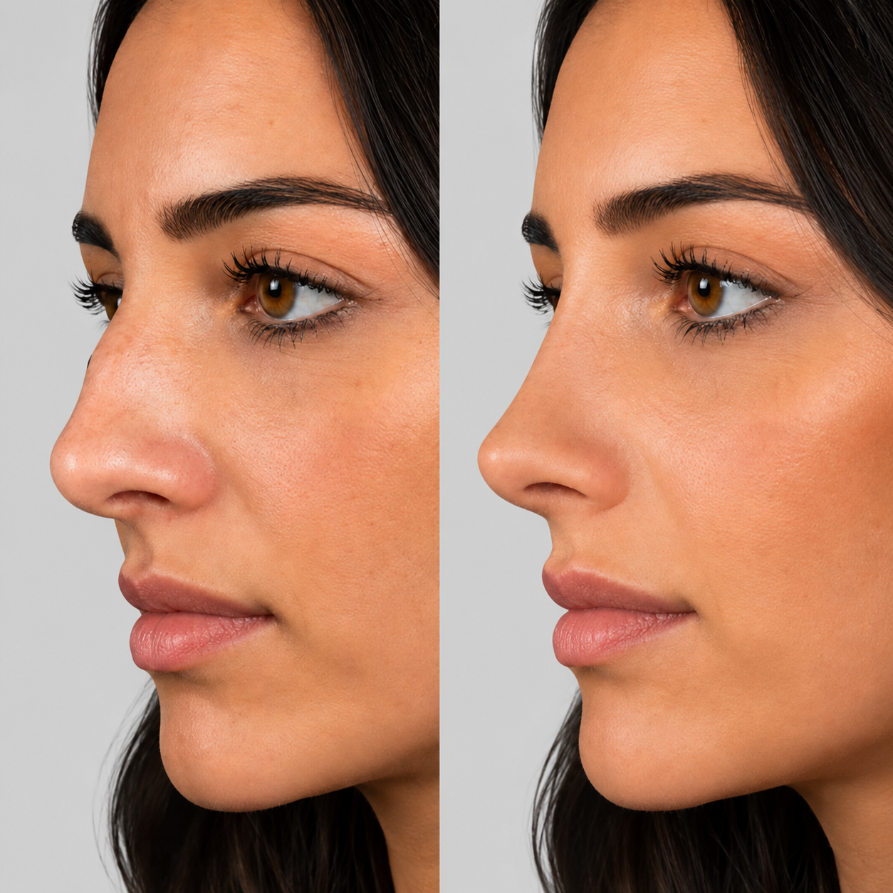 Rhinoplasty