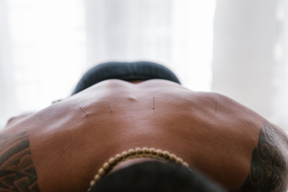 acupuncture-therapy